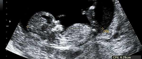 An ultrasound scan of a growing baby.